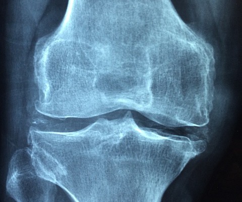 Arthrose