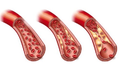 Arteriosklerose Fotolia 45760283 C axel kock e1527176737962