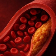Medizinische Illustration einer verengten Arterie mit Plaque-Ablagerungen und Blutkörperchen im Querschnitt